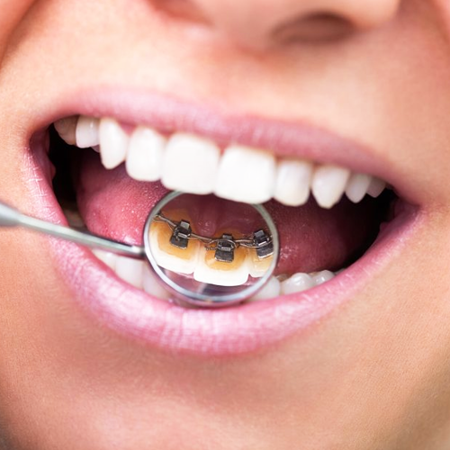 Lingual Braces