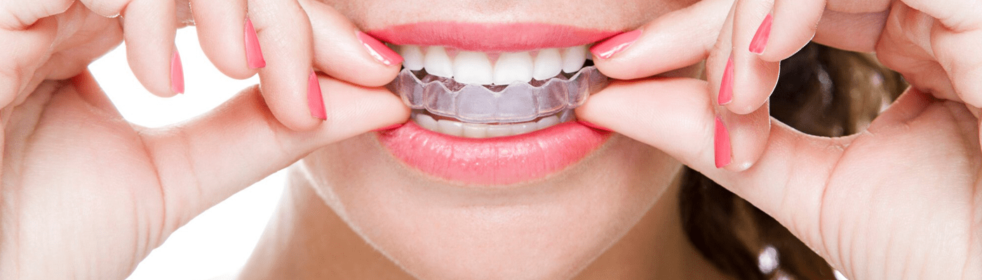 Clear Aligners (invisible Braces)