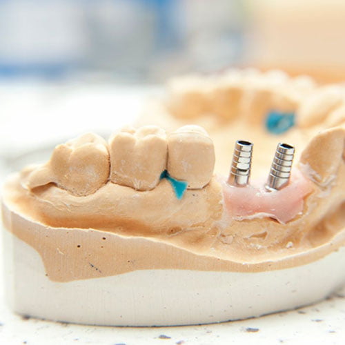 Multiple Teeth Implants