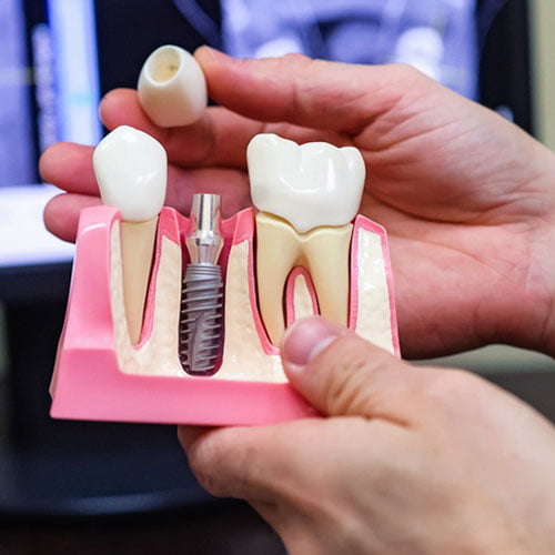 Nobel Guide Computer Guided Surgery