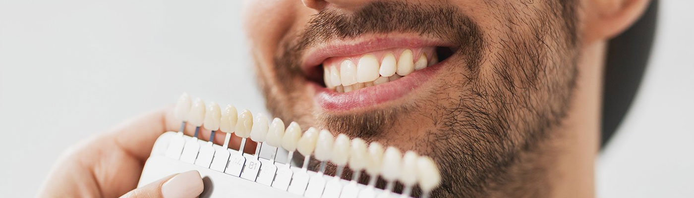 No Prep / Prepless Veneers