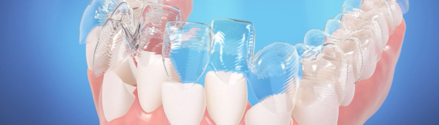 Crooked Tooth Correction