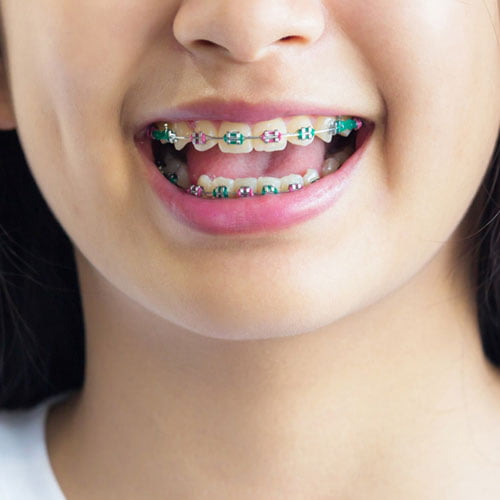 Crooked Tooth Correction